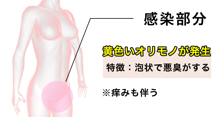 トリコモナスの症状