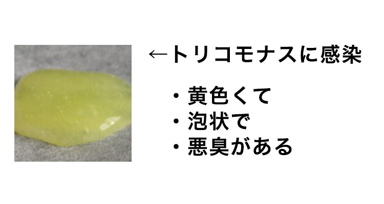 黄色いオリモノ