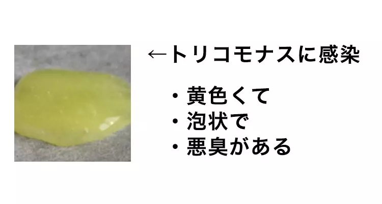 トリコモナスの症状と原因を詳しくまとめました 治療でちゃんと完治します