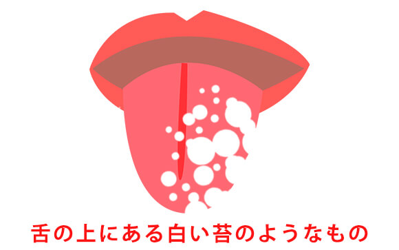 舌苔（ぜったい）