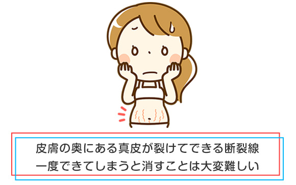 妊娠線とは