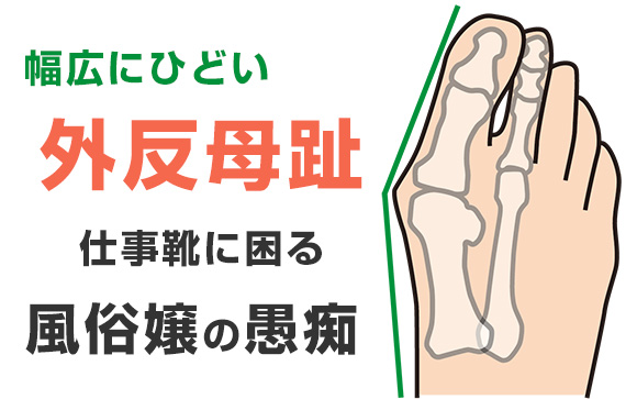 幅広にひどい外反母趾…仕事靴に困る風俗嬢の愚痴