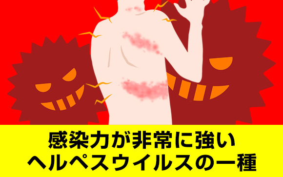 帯状疱疹の症状