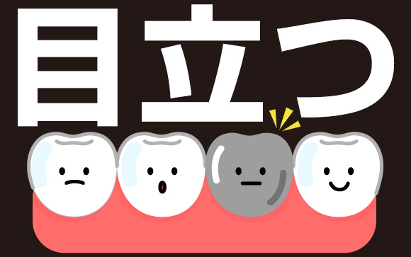 銀歯はかっこ悪い