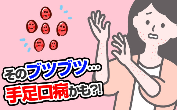 そのブツブツ、性病じゃなく手足口病かも?!夏風邪流行中！